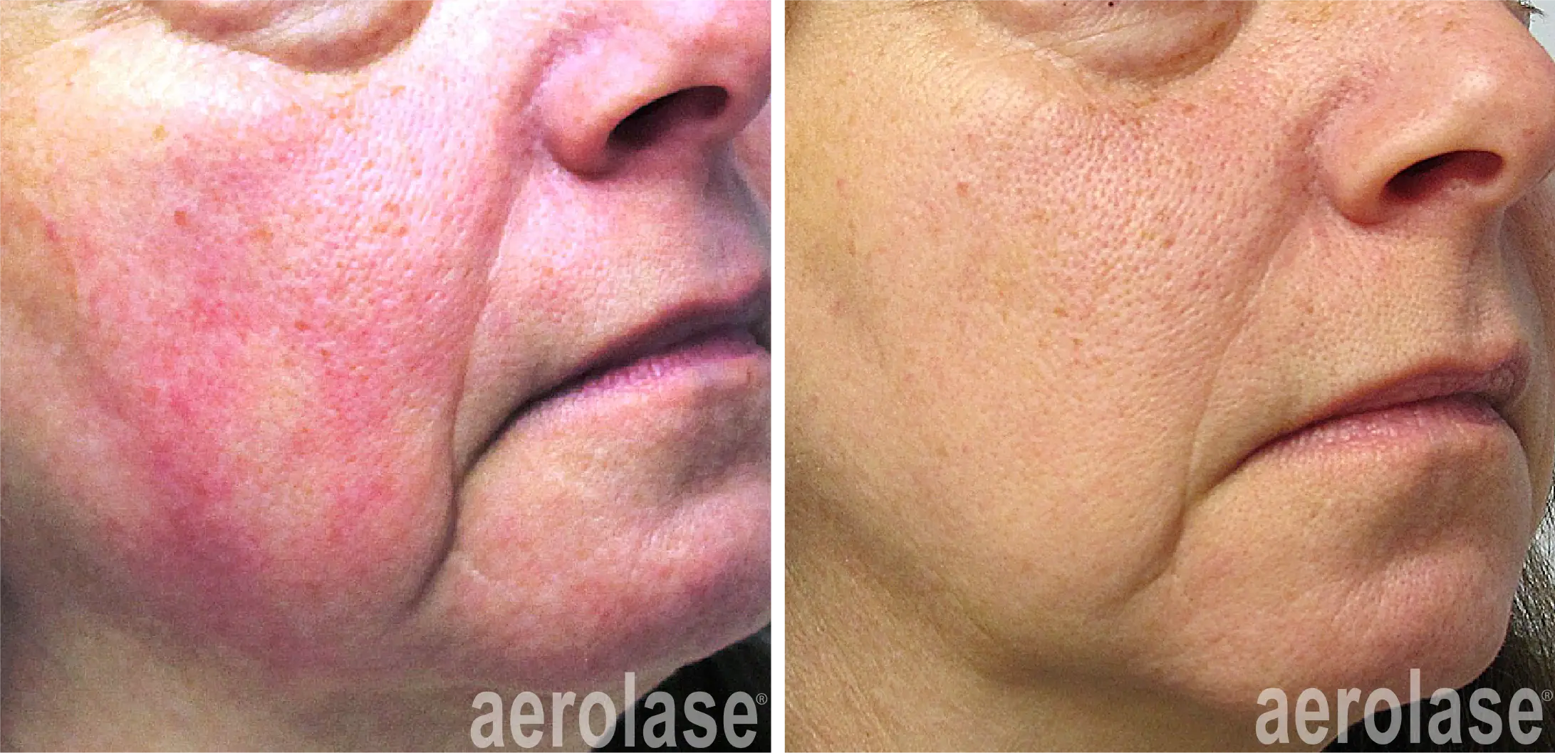 Rosacea - Photos courtesy of yelena kipervas MD