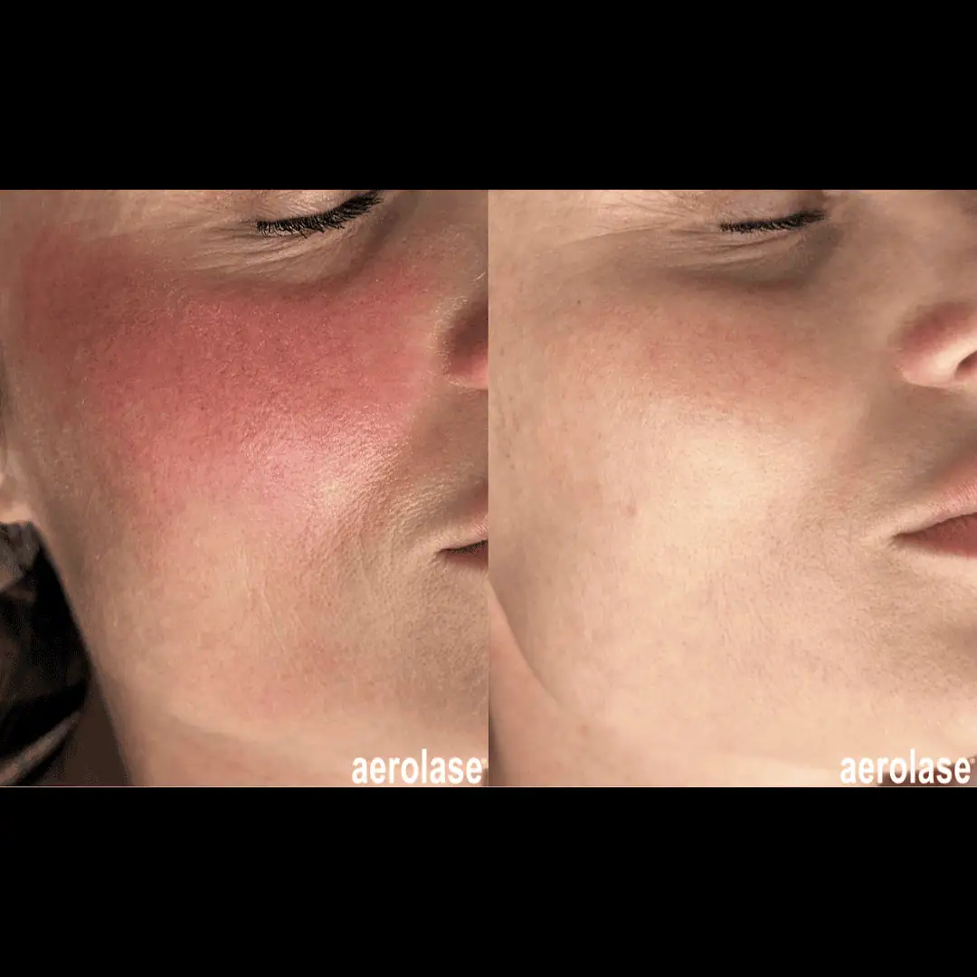Rosacea