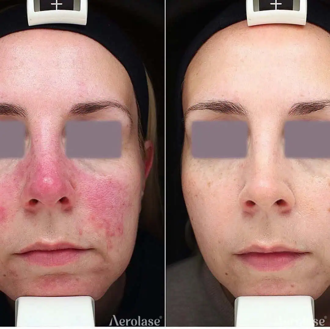 Rosacea - Photos courtesy of La Derma Beograd