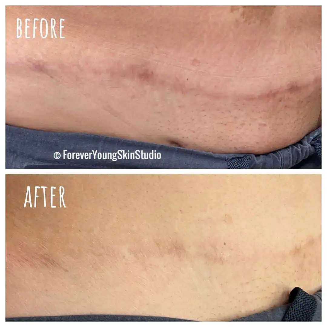 Scar Reduction