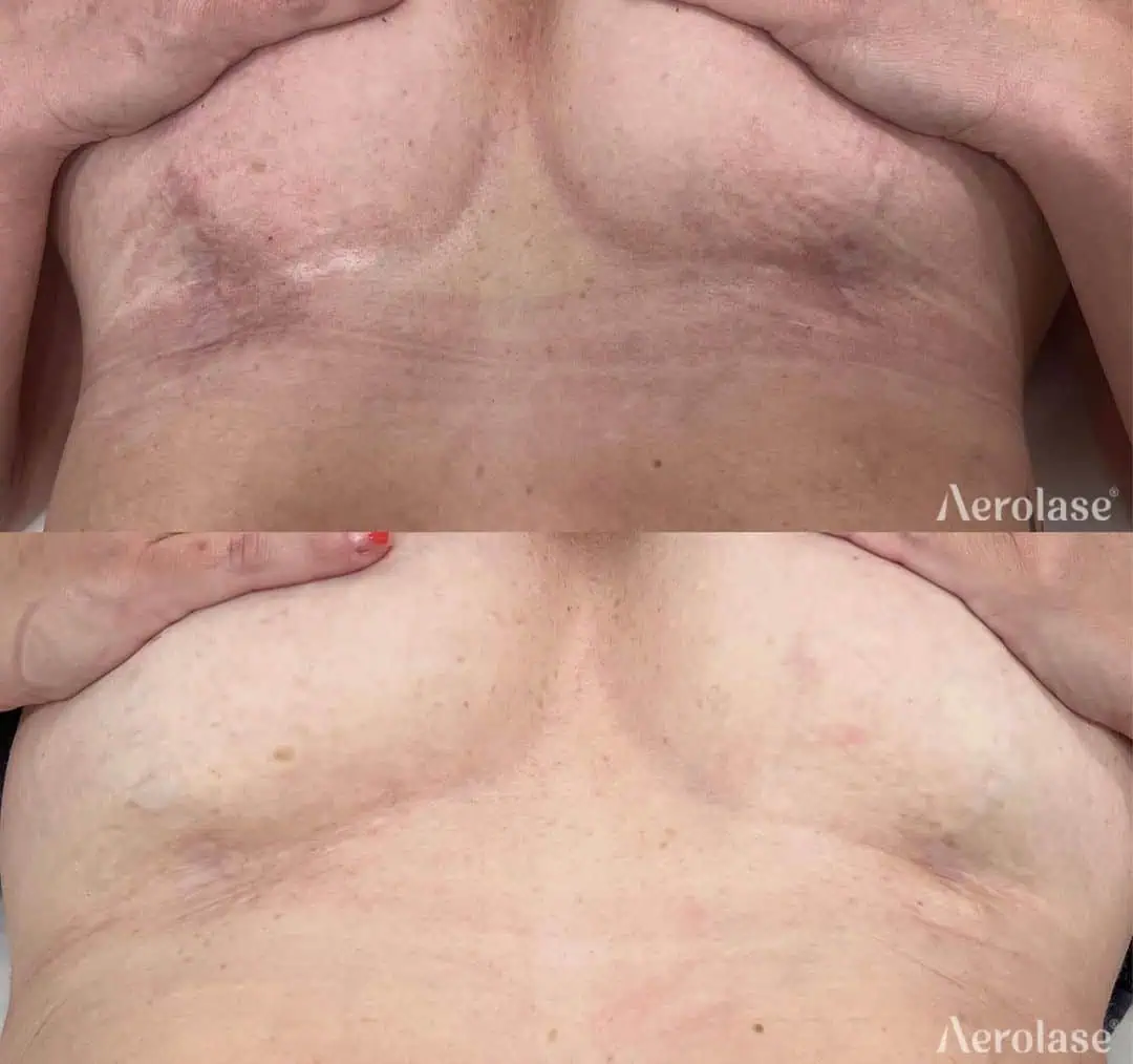 Scar Reduction - Photos courtesy of Aesthetic NP Kristen