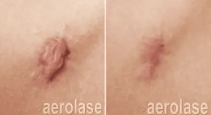Scar Reduction