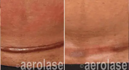 Scar Revision