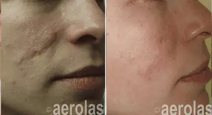 Scar Revision