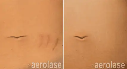 Scar Revision
