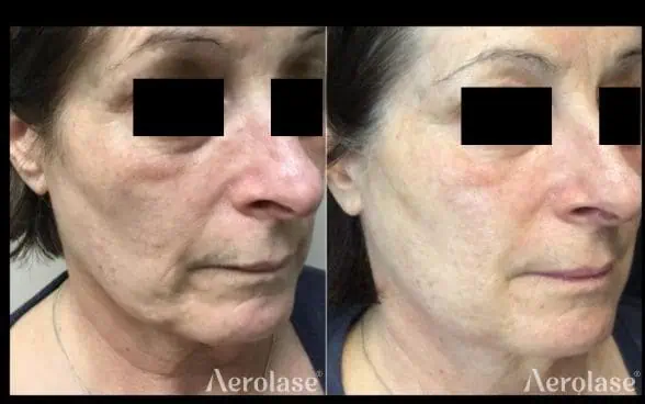 Skin Rejuvenation (Face)