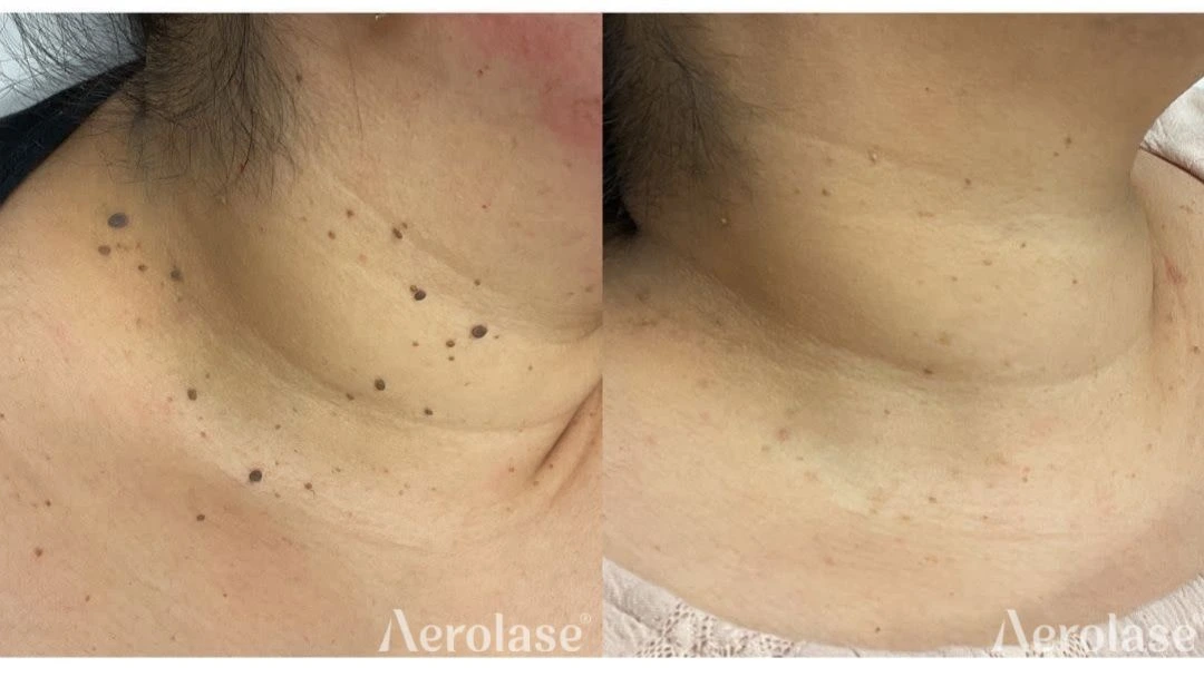 Skin Tags - Photos courtesy of Luminescence Aesthetic