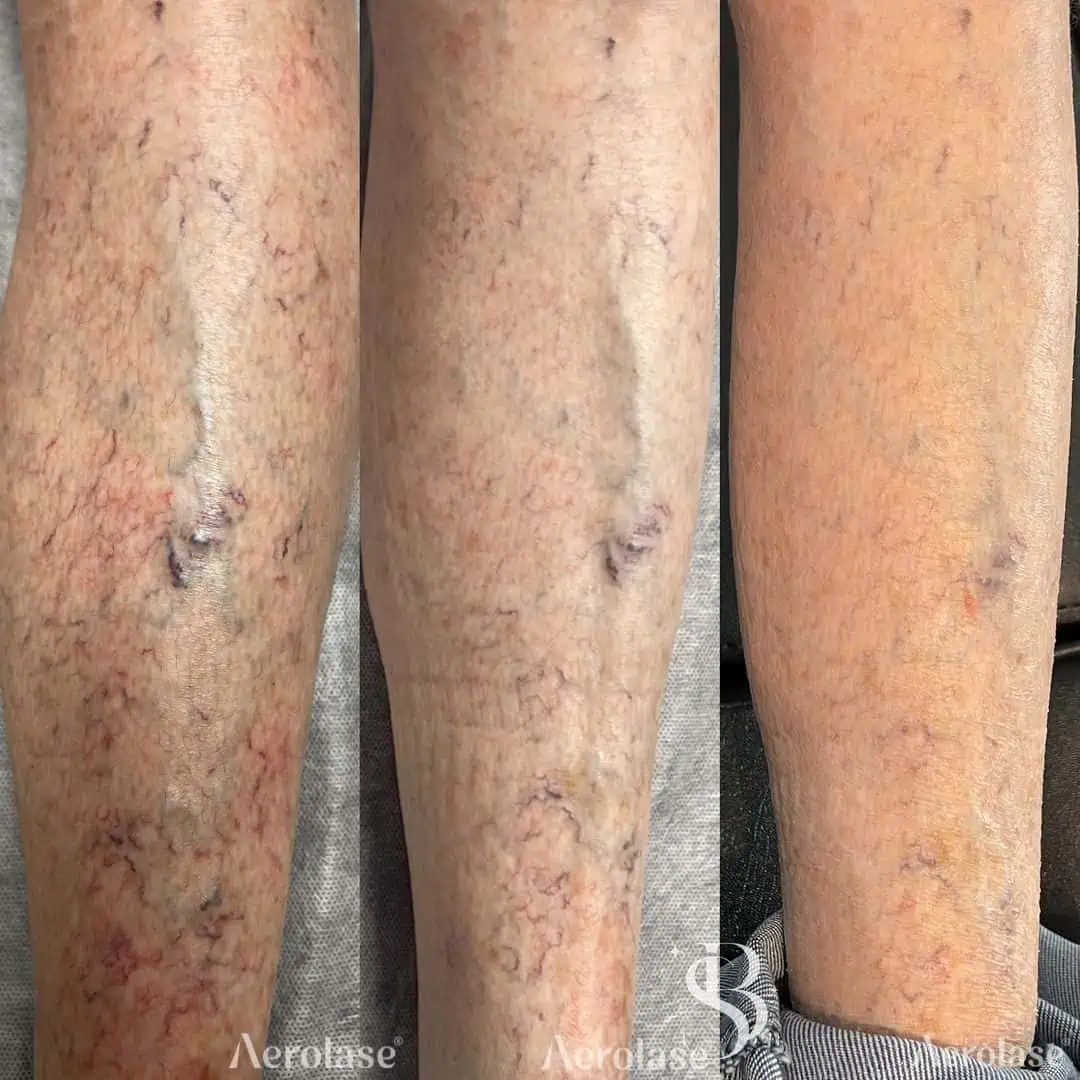 Spider Veins (Leg) - Photos courtesy of Scarlett Beauty
