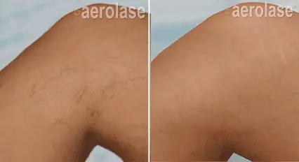 Spider Veins