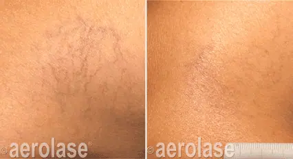 Spider Veins
