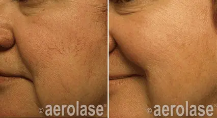 Spider Veins