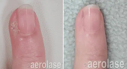 Wart