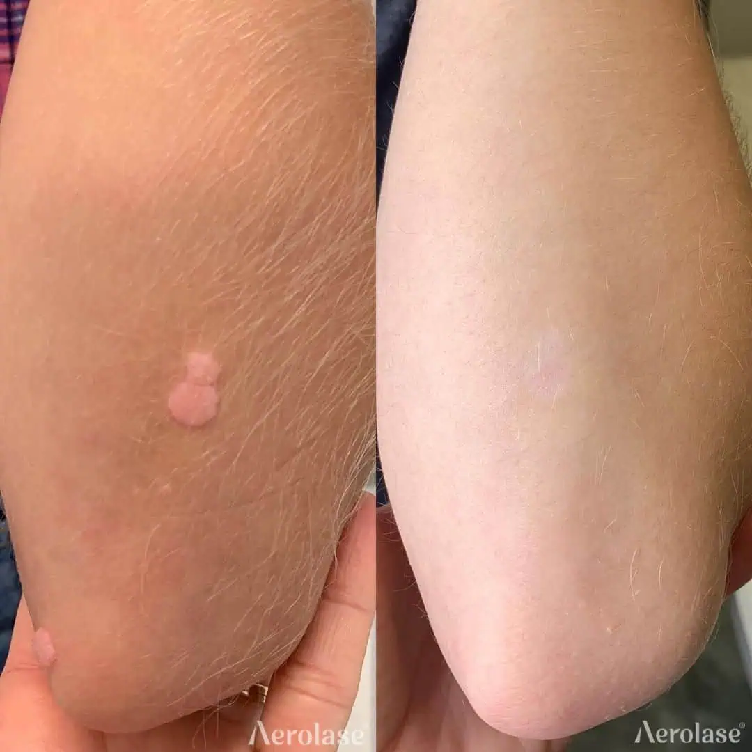 Warts - Photos courtesy of Elevate Wellness and Aesthetics
