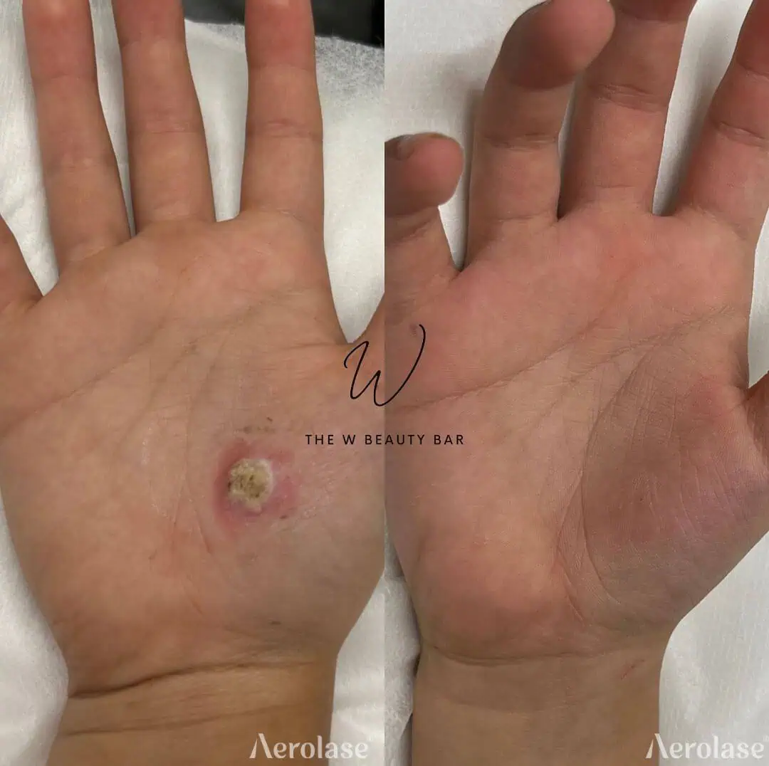 Warts - Photos courtesy of The W Beauty Bar